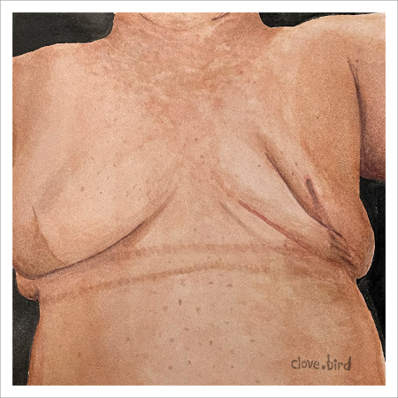 Mastectomy and Implant Scars Print