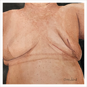 Mastectomy and Implant Scars Print