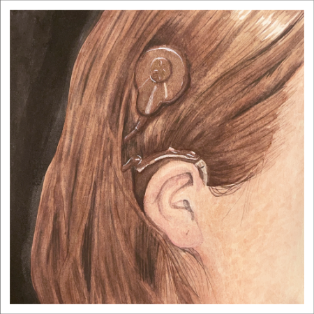Cochlear Implant Original