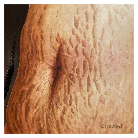 Stretch Marks 1 Original