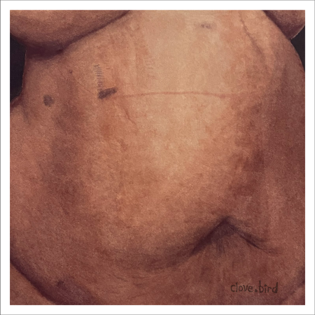 Gallbladder Scar Original